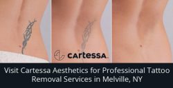 Visit Cartessa Aesthetics for Professional Tattoo Removal Services in Melville, NY