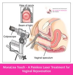 MonaLisa Touch – A Painless Laser Treatment for Vaginal Rejuvenation