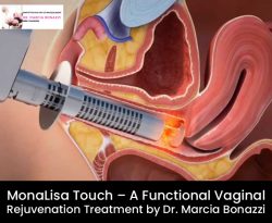 MonaLisa Touch – A Functional Vaginal Rejuvenation Treatment by Dr. Marcia Bonazzi