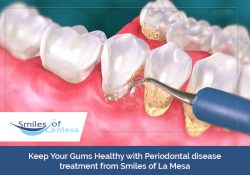 Keep Your Gums Healthy with Periodontal disease treatment from Smiles of La Mesa