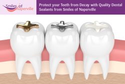 Protect your Teeth from Decay with Quality Dental Sealants from Smiles of Naperville