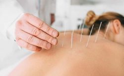 Best Acupuncture