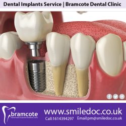 Dental Implants Service | Bramcote Dental Clinic