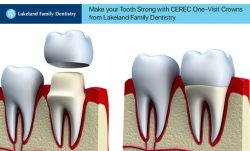 Make your Tooth Strong with CEREC One-Visit Crowns from Lakeland Family Dentistry