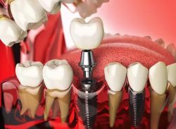 Dental Implant Dentist In Lynnwood