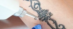 Tattoo Removal in Chandigarh