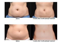 Coolsculpting in Santa Clara | Mendhair.com