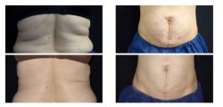 Coolsculpting in fremont CA | Mendhair.com