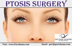 Ptosis Surgery At Pari Shams