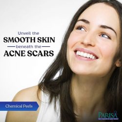 Acne Scar Treatment in Chandigarh