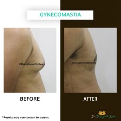 Gynecomastia Treatment in Hyderabad