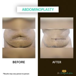 Abdominoplasty Cost in Hyderabad