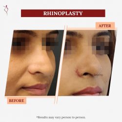 Best Nose Surgeon in Dubai