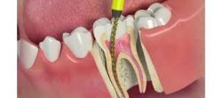 What Makes Teeth Crooked, Why that Could Be and What Can Be Done?