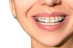 Why are Dental Braces Colors Important?