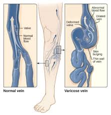 Varicose Vein Center in Long Island