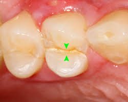 Deep Cleaning Teeth Aftercare