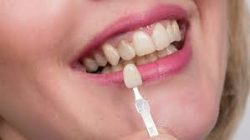 Top Ways To Improve Your Smile – Houston Dental Surgery