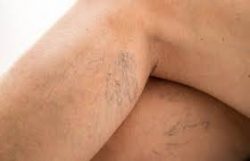 Spider Vein Doctor in Long Island