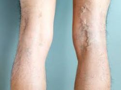 Varicose Veins Treatment Houston TX