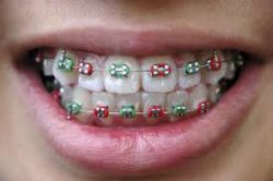 Need Bracket Braces For Childrens