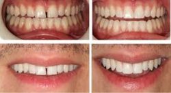 Cosmetic Bonding Dentist in Houston Tx