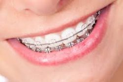 DO I NEED CERAMIC BRACES?