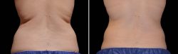 Coolsculpting in Philadelphia by Dr. Gambhir