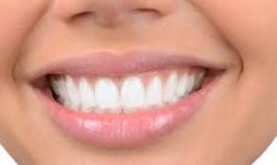 Cosmetic Dental Implants Services in Clute Texas