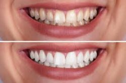 Cosmetic Teeth Whitening Houston TX