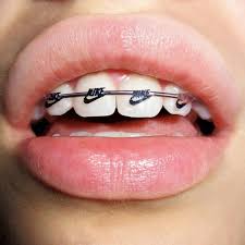 BRACES TIE COLORS INTRODUCTION