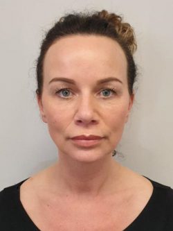 Premium Dermal fillers Bristol