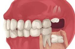 Wisdom Teeth Extraction Houston TX