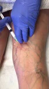 Top Varicose Vein Doctors Near Me