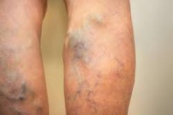 Varicose vein doctors in Houston