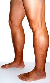 Stages of Chronic Venous Insufficiency