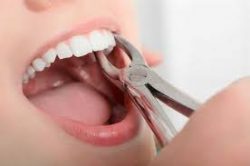 Tooth Extraction Procedure