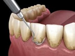 Periodontal Scaling And Root Planing