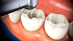 Root Canal Treatment in Houston