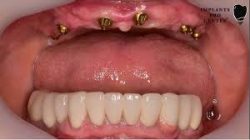 Dental Implants Houston, TX