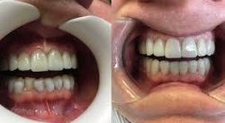 Cosmetic Dental Bonding Treatment in Houston