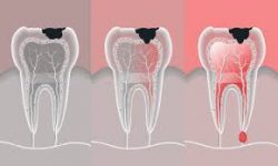 Dental Root Canal Treatment Houston