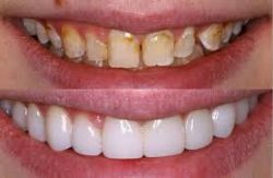 Dental Veneers in Houston TX