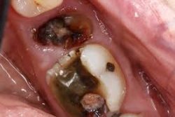 Emergency Tooth Infection Treatment in Houston