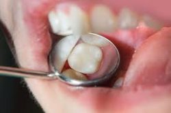 Dental Tooth Fillings in Houston