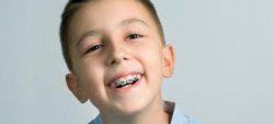 How Much Do Braces Cost For Kids?