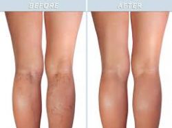 Varicose Veins Treatment Near Me