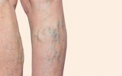 Spider Veins Clinic Near Me