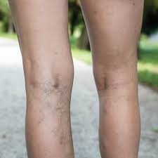 Varicose Vein Treatment Center Wayne