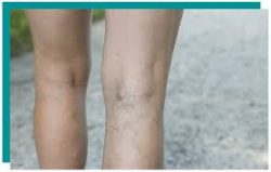 Spider Vein Treatment Houston TX